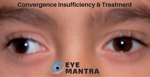 Convergence Insufficiency: What Is It, Symptoms and Treatments