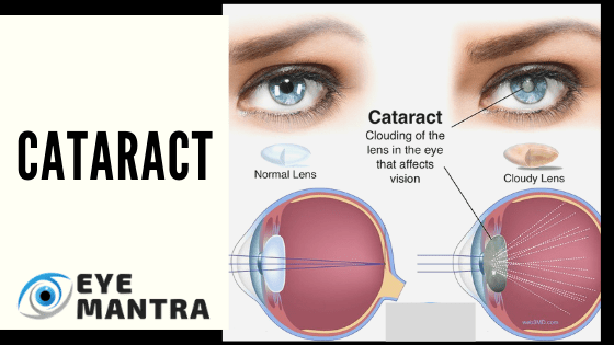 Cataracts: Types, Causes and Tips for preventing