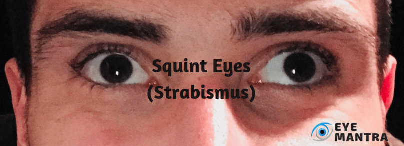 Squint Eyes Strabismus