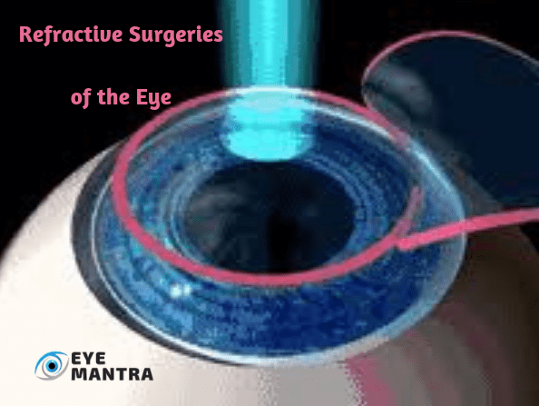 Refractive Surgery for Refractive Errors, Types of Treatment & Risks