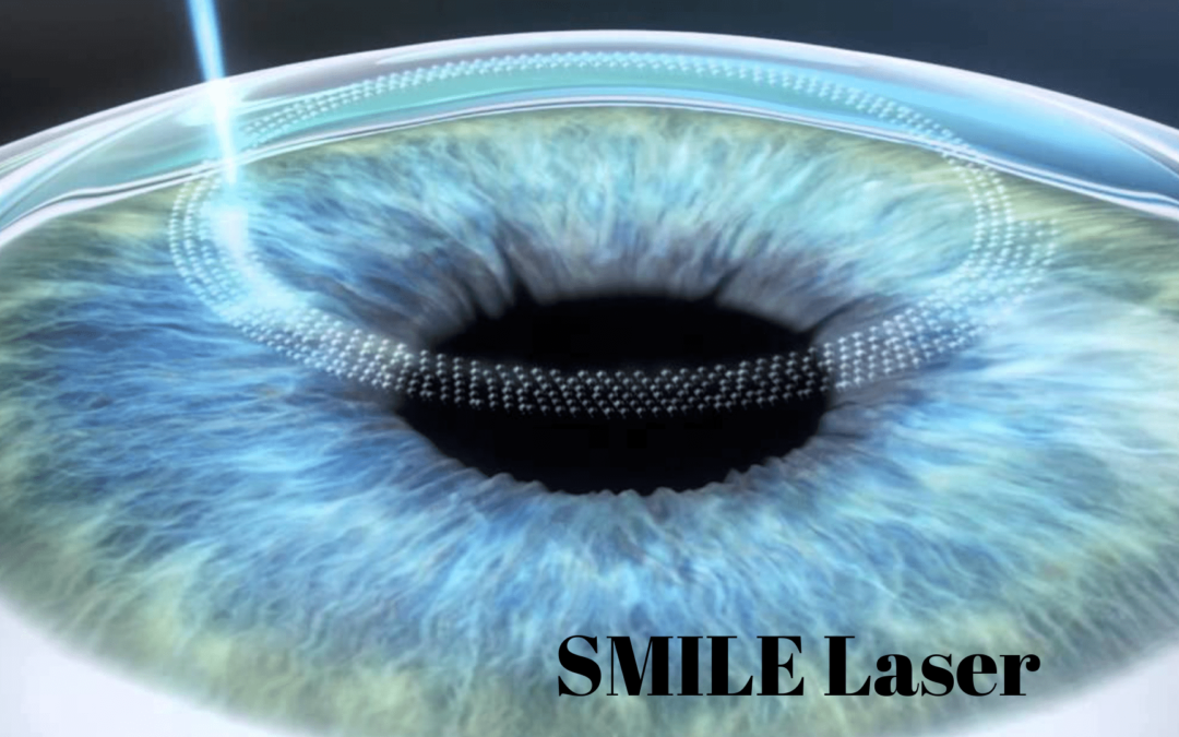 SMILE Laser Surgery: Causes, Symptoms, & Treatment
