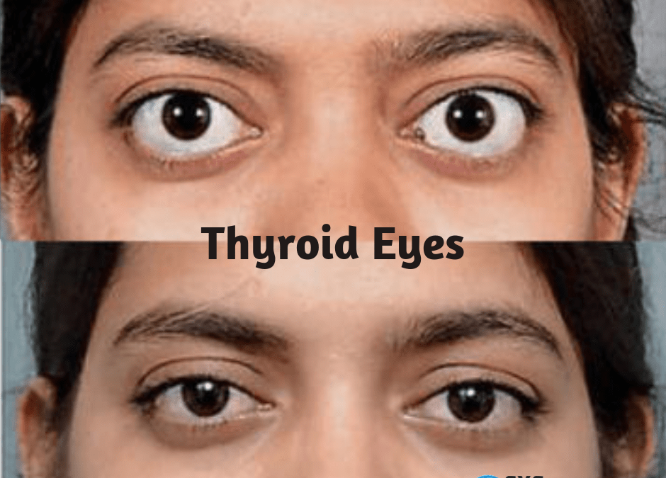 thyroid-eye-disease-risks-symptoms-causes-treatment-eyemantra