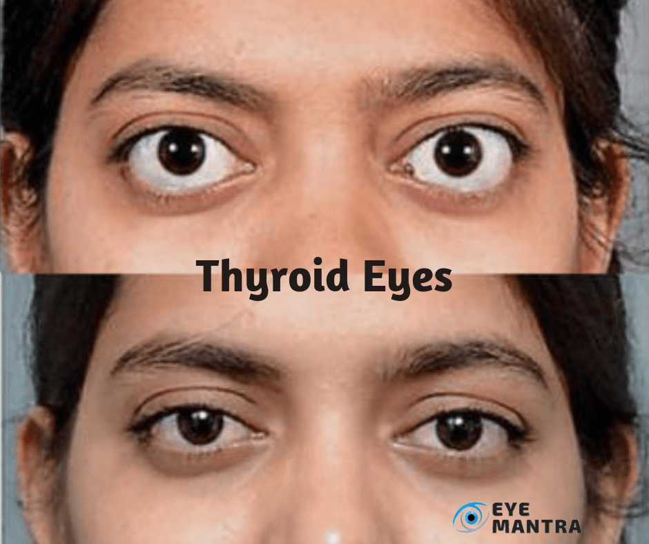 Hyperthyroidism Eyes Before And After