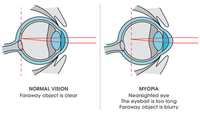 Normal Vision vs Vision in Myopia