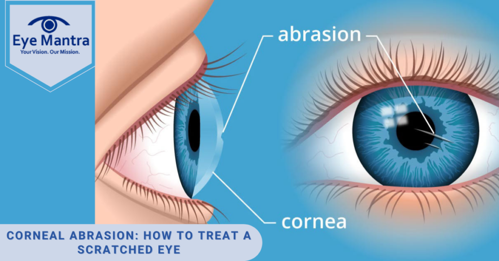 corneal abrasion