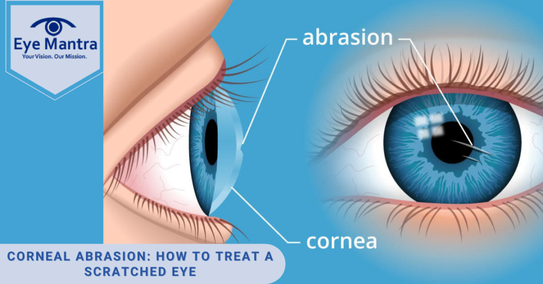 Corneal Abrasion: How to Treat a Scratched Eye | Eyemantra Hospital