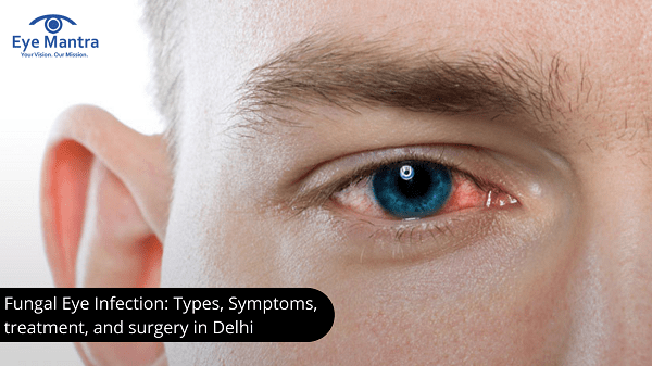 Fungal Eye Infection Types, Symptoms, treatment, and surgery in Delhi-min