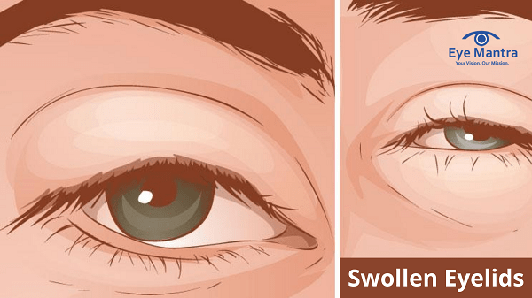 Swollen Eyelids