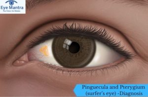 Pinguecula and Pterygium (surfer’s eye) -Diagnosis and Treatment