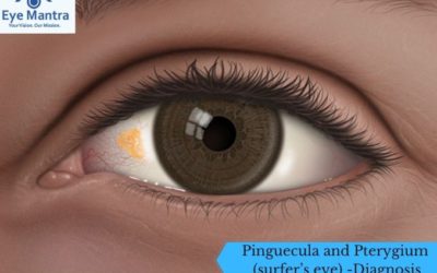 Pinguecula and Pterygium (surfer’s eye) -Diagnosis and Treatment