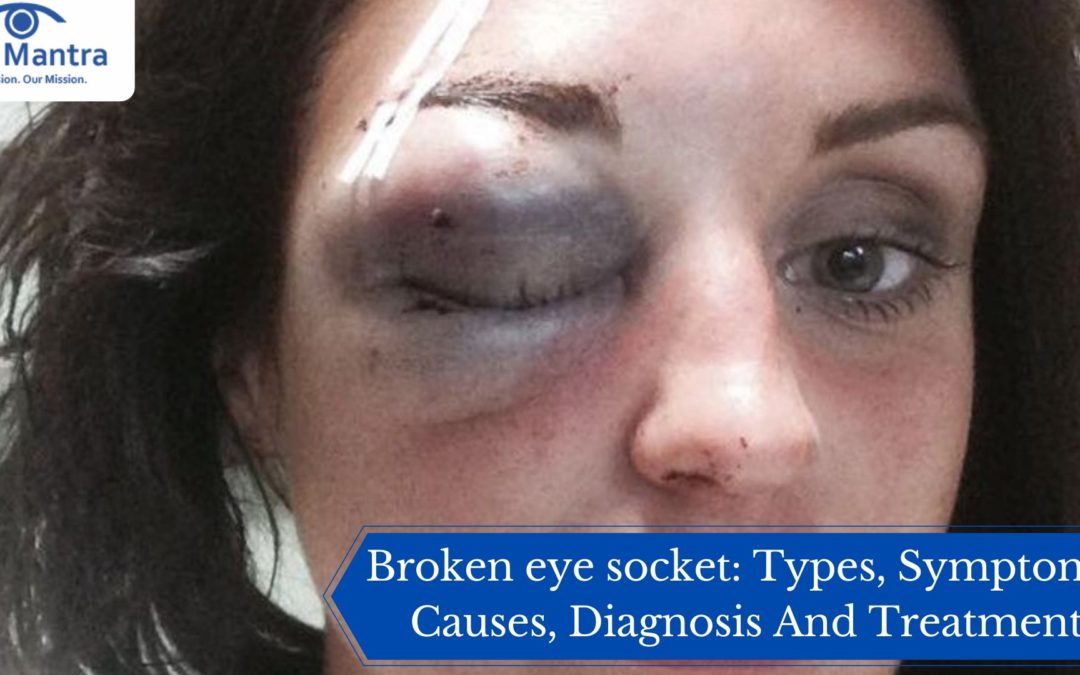 Broken eye socket: Types, Symptoms, Causes, Diagnosis And Treatment