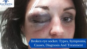Broken eye socket: Types, Symptoms, Causes, Diagnosis And Treatment