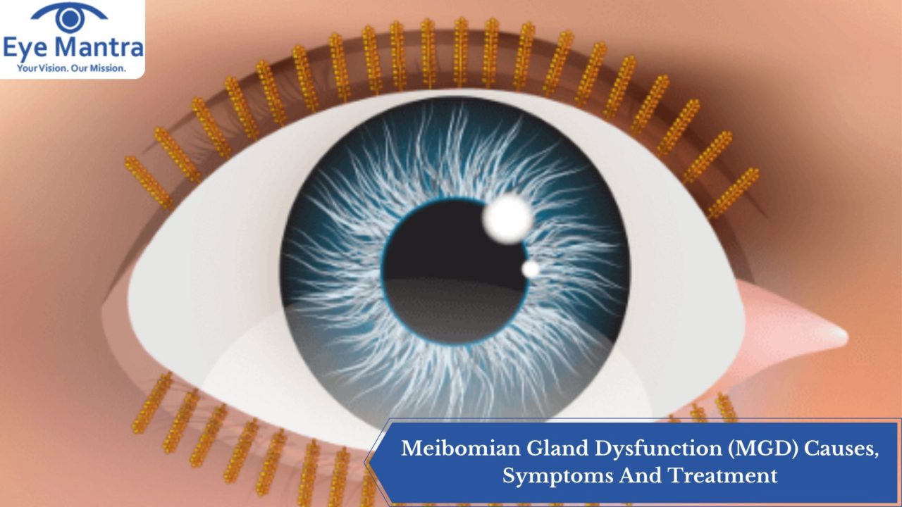 Meibomian Gland Dysfunction Mgd Causes Symptoms And Treatment 