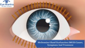 Meibomian Gland Dysfunction (MGD) Causes, Symptoms And Treatment