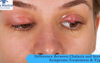 Difference Between Chalazia and Styes – Symptoms,Treatement &Types