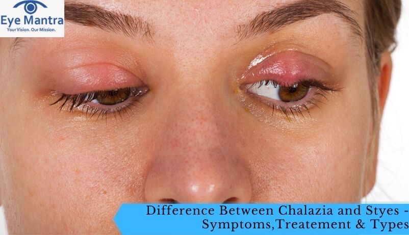 Difference Between Chalazia and Styes – Symptoms,Treatement &Types