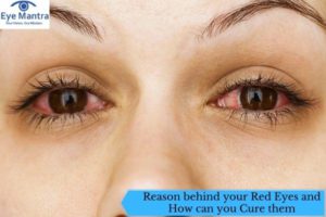 Reason behind your Red Eyes and How can you Cure them