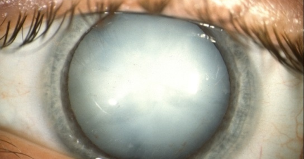 cataract-surgery.