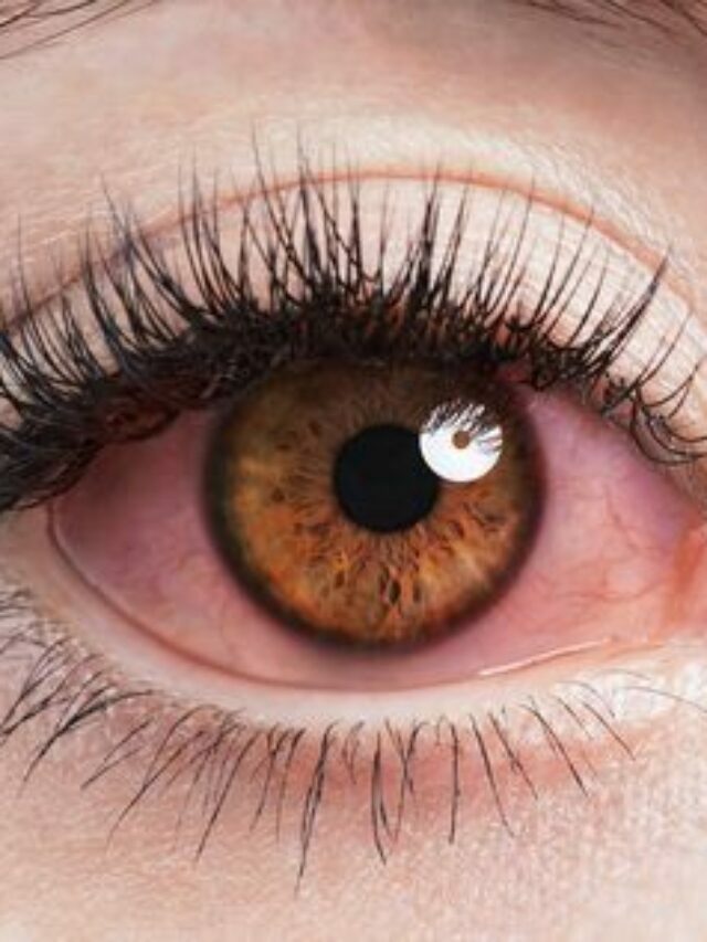 7 Symptoms of Eye Conjunctivitis (pink eye)