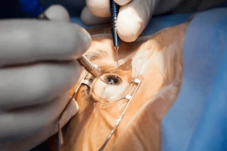 Introduction to Laser-Assisted Cataract Surgery