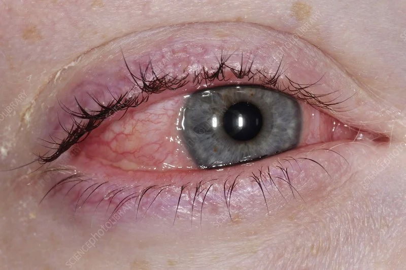  Common Causes of Allergic Conjunctivitis