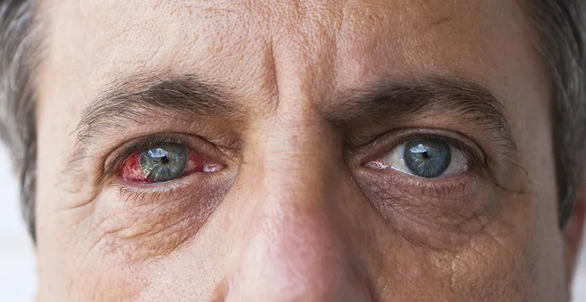 Common Eye Problems Caused by Diabetes