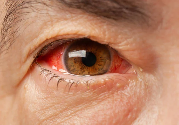 Symptoms of Allergic Conjunctivitis