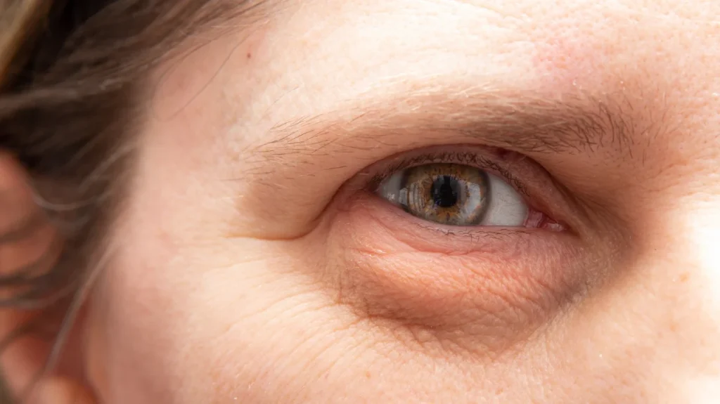 Understanding the Causes of Puffy Eyes