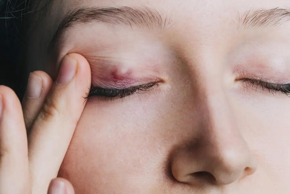 What is an Eye Chalazion?