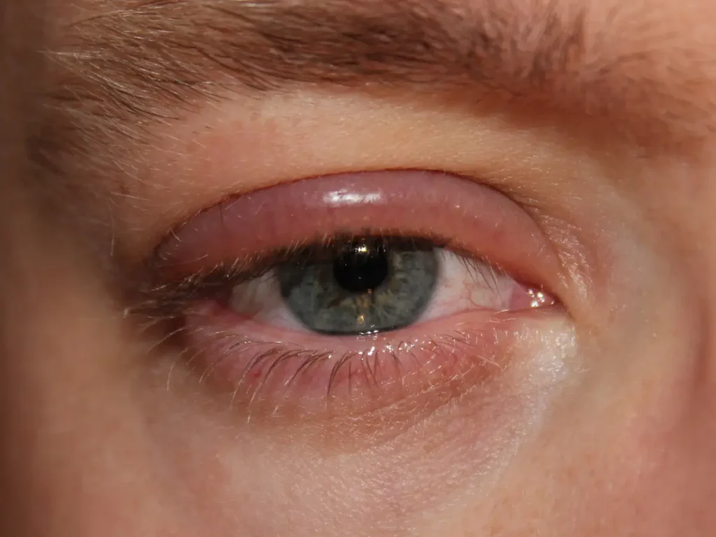 Recognizing the Symptoms of Blepharitis