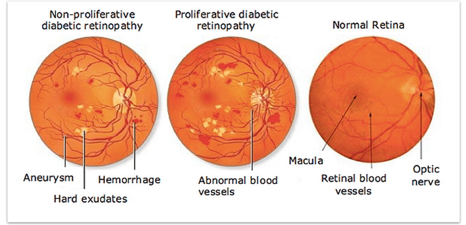 Stages of Diabetic Retinopathy