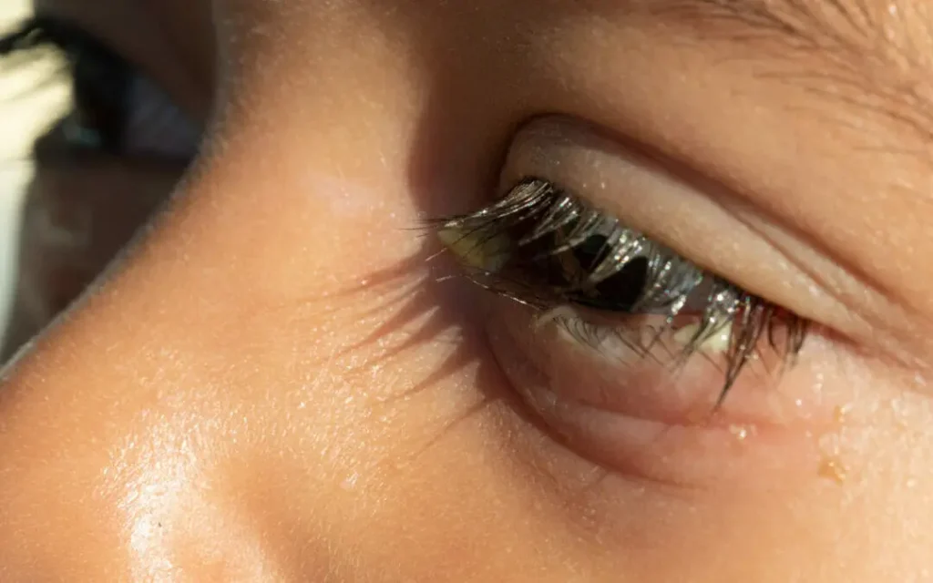 Understanding Blepharitis