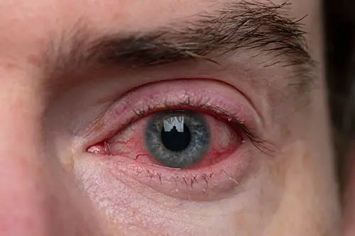 Understanding Bloodshot Eyes