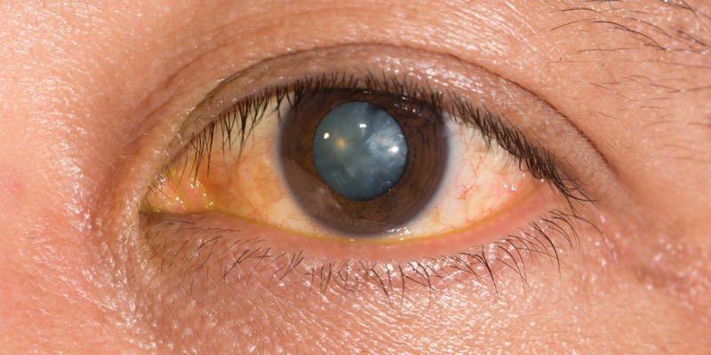 Cataract